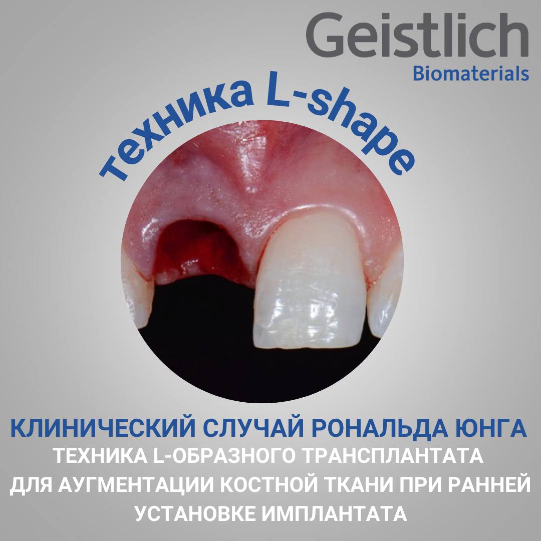 Техника L-shape. Клинический случай Рональда Юнга